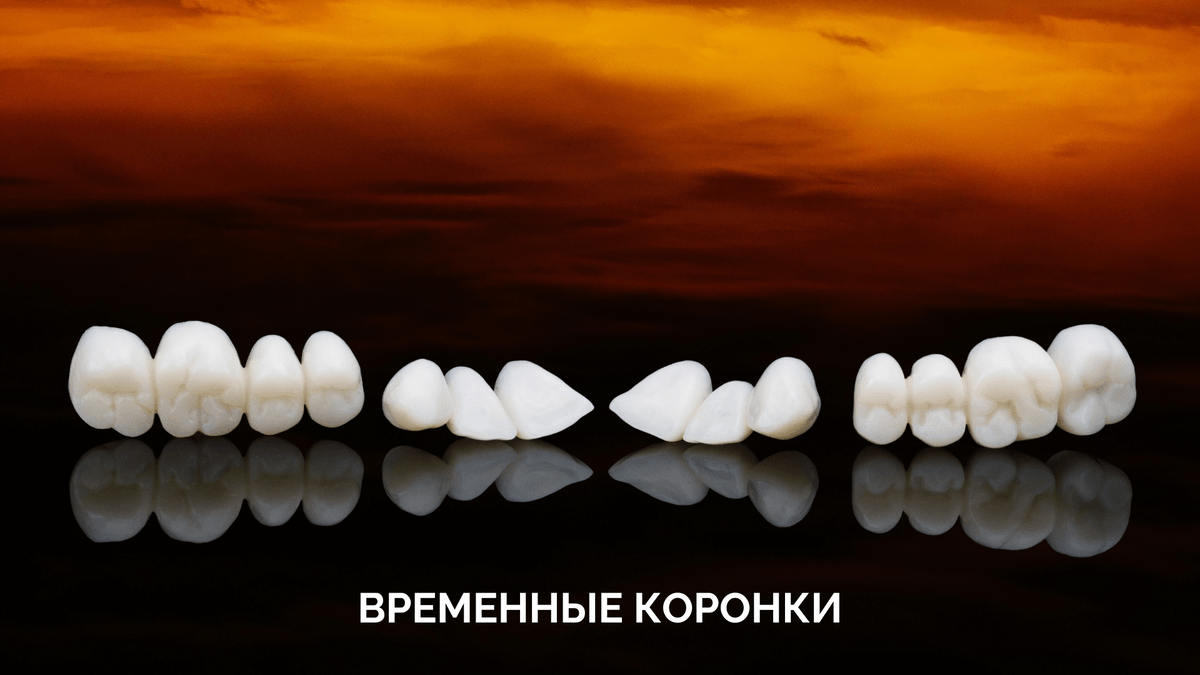 Временная коронка на зуб: зачем и когда менять?