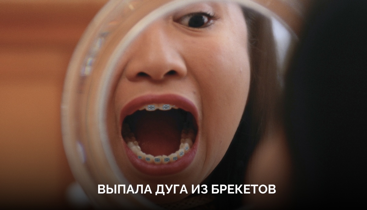 Выпала дуга из брекетов? Советы ортодонта