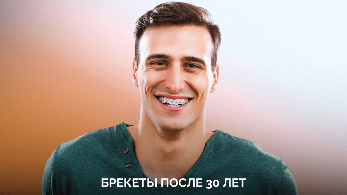 Брекеты после 30 лет – деньги на ветер?