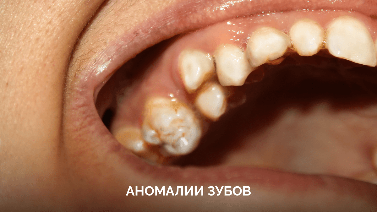 Аномалии зубов: какие бывают и что с ними делать?