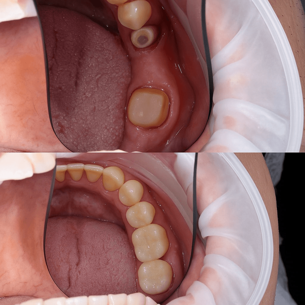 МОСТОВИДНОЕ ПРОТЕЗИРОВАНИЕ
